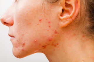 Quand apparaissent les effets secondaires de Roaccutane ?