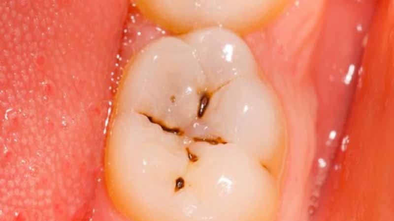 C’est quoi une Nevralgie dentaire ?