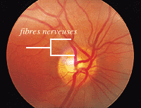 Comment savoir si le nerf trijumeau est atteint ?