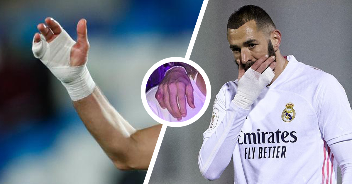 Pourquoi Karim Benzema joue avec un bandage à la main droite ?